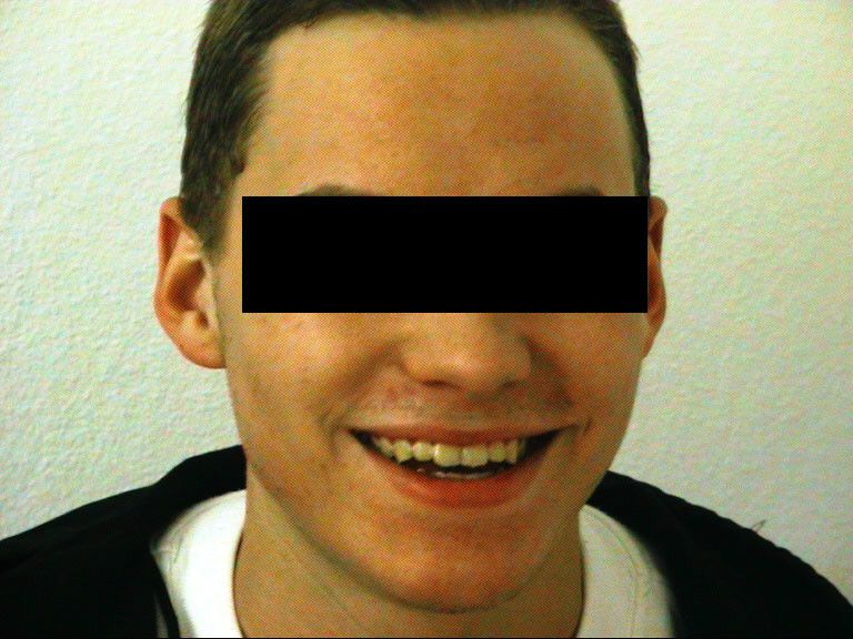 Nach sechs mal Microdermabrasion